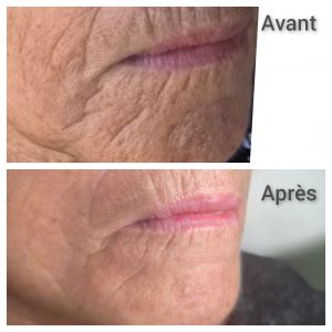 Résultat avant/après soin radiofréquence visage